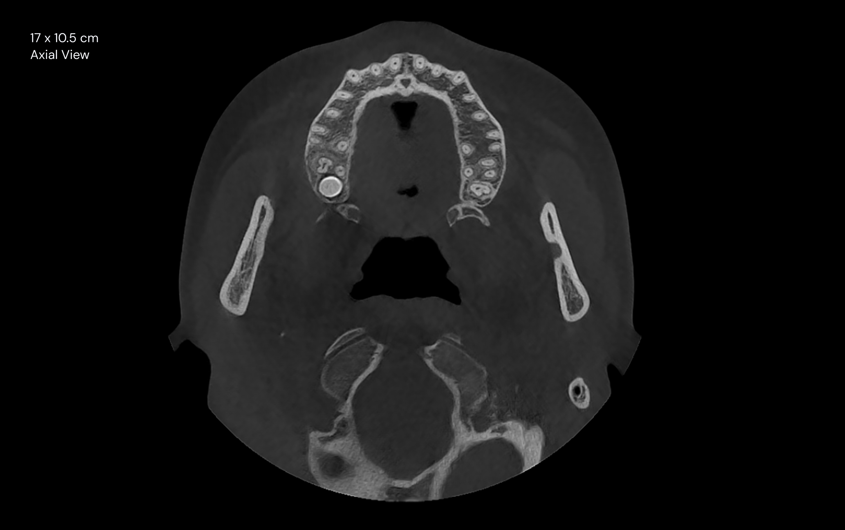 17 x 10.5 cm Axial View